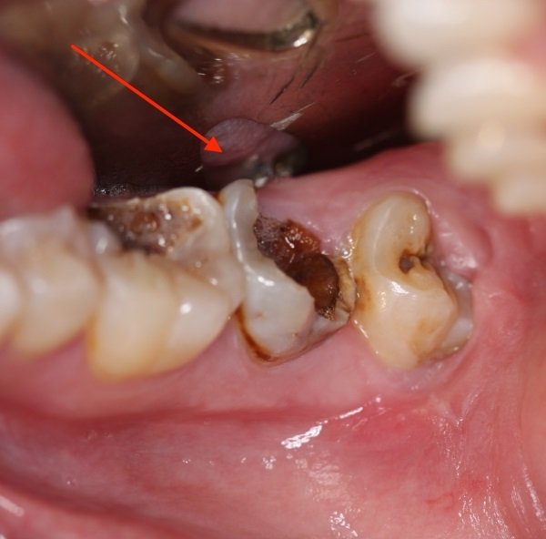 Răng hàm sâu bị vỡ có nguy hiểm không