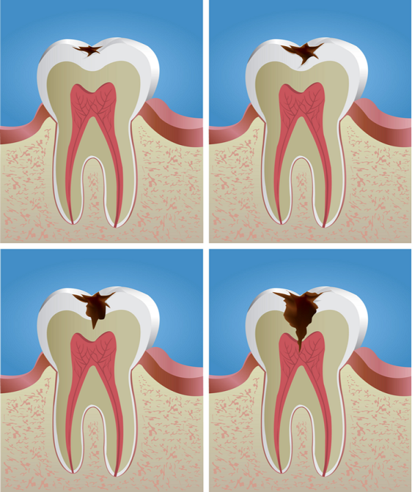 Cách giai đoạn sâu răng
